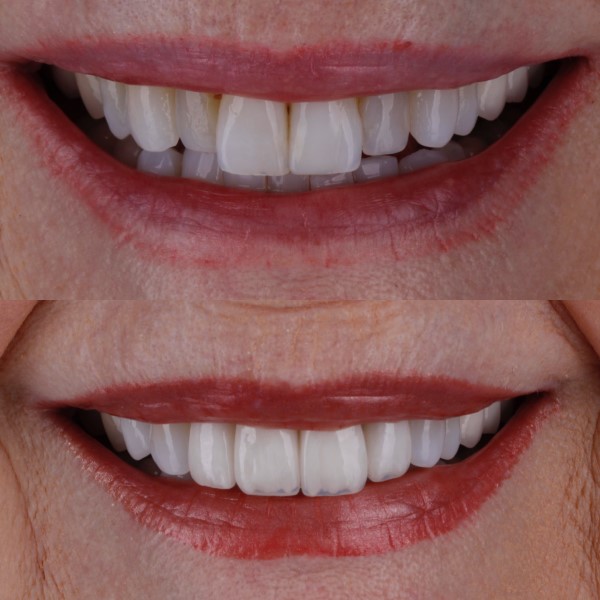 images/smile-gallery/6D14DF49-0DF9-423C-B3A9-151EE9F84BD5.jpg